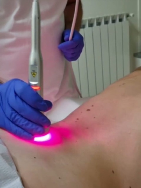 Laserterapia sulla spalla
